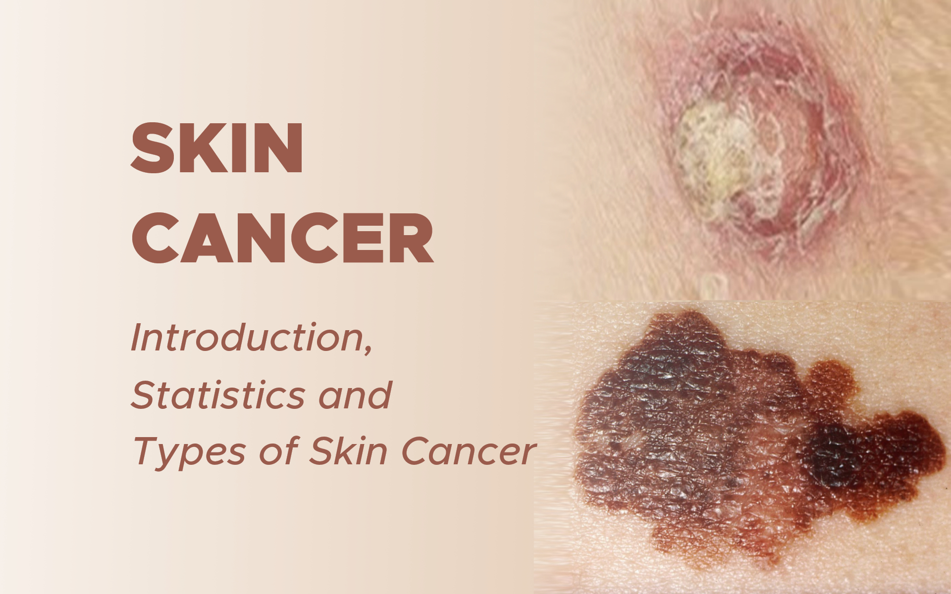 Skin Cancer Introduction Statistics And Types Of Skin Cancer Gynecoloncol 
